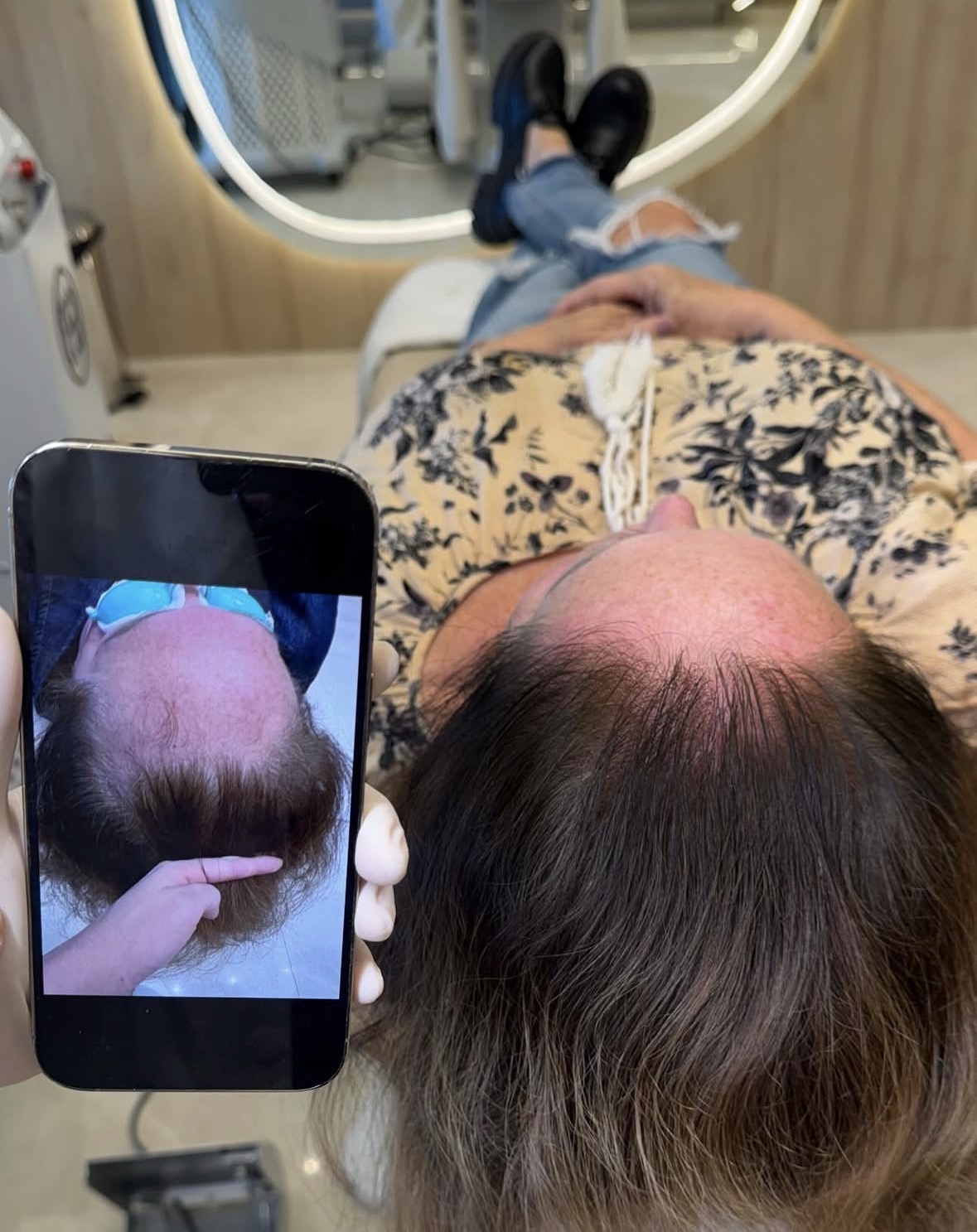 Antes e depois de densidade capilar após regeneração com exossomos