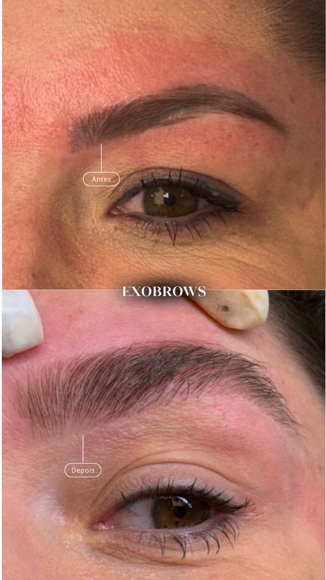 Antes e depois de regeneração de sobrancelhas com exossomos