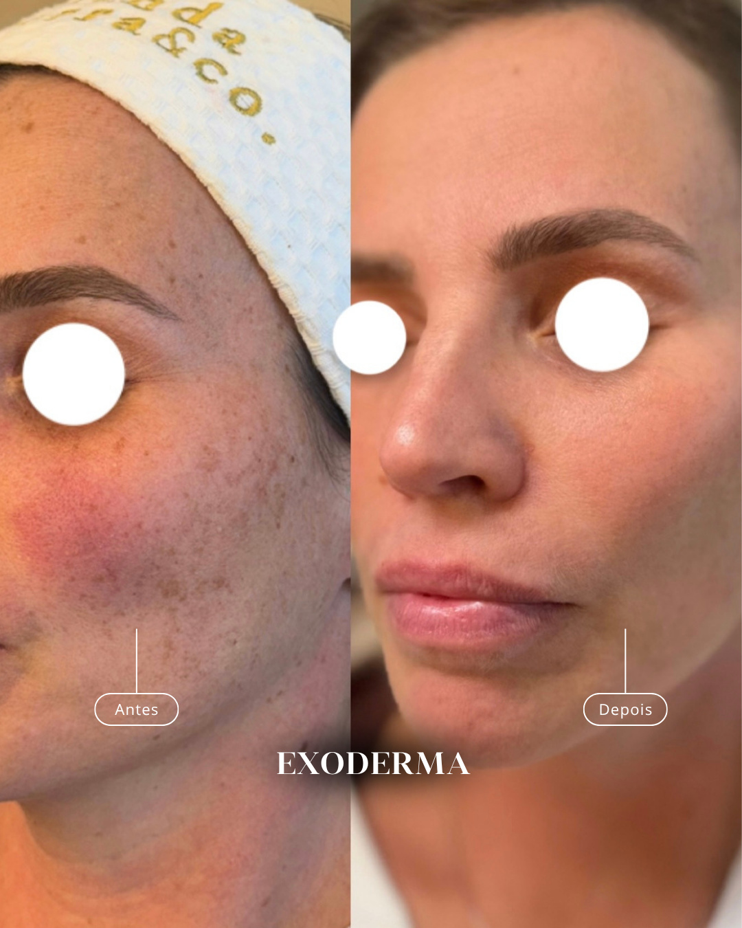Antes e depois de pele com marcas suavizadas por exossomos