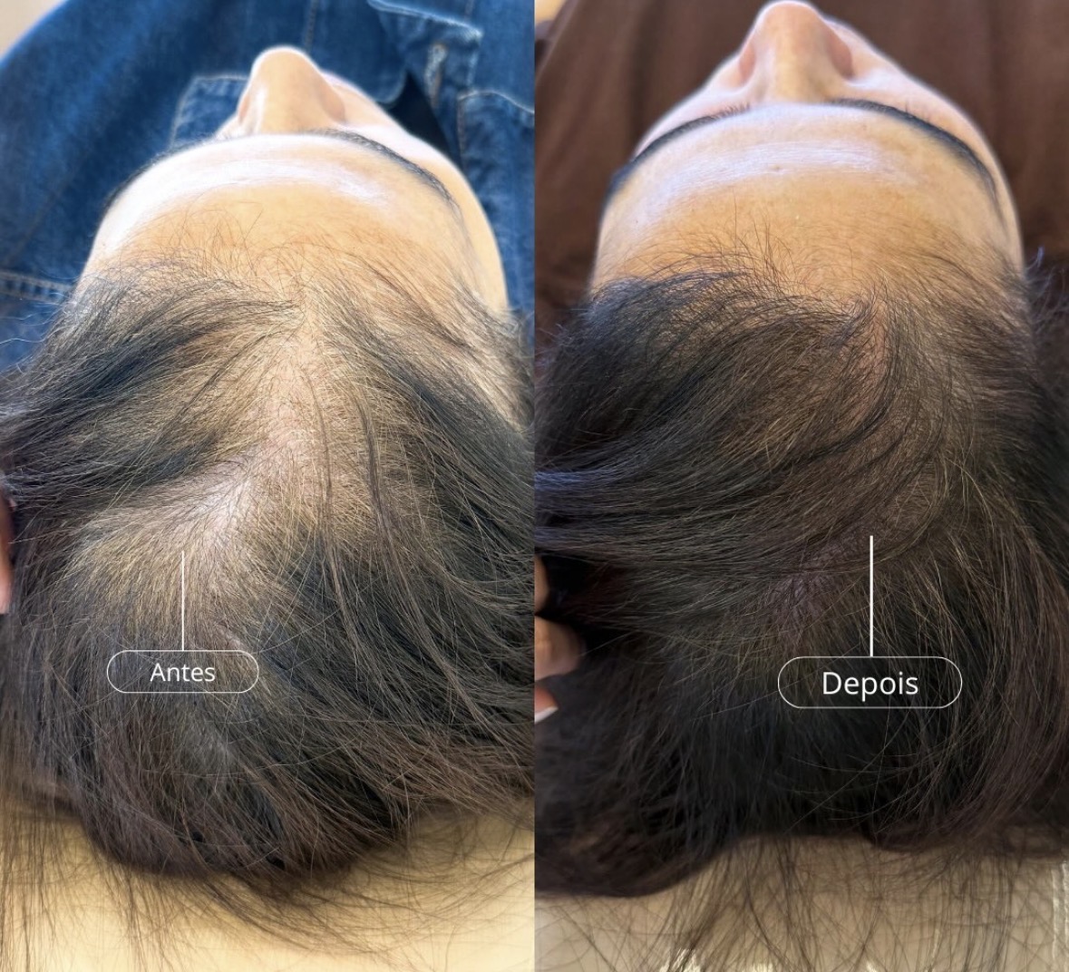Antes e depois de regeneração de cabelos com exossomos