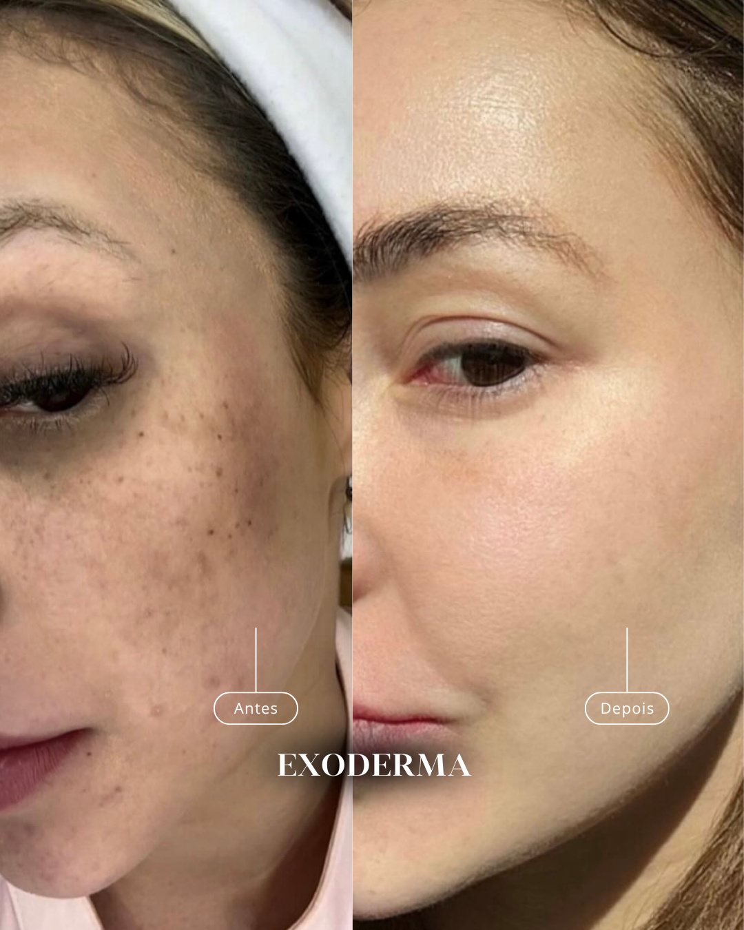Antes e depois de regeneração de pele com exossomos